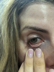 Anemia