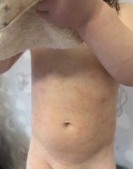 Could this be chicken pox?