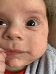 CMPA rash or acne/dermatitis?