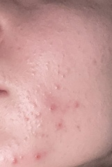 Acne/ face ?
