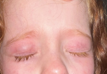 Swollen eye 3 year old