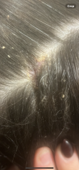Open sores on scalp