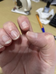 Proven treatments for natural peeling nails