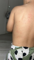 Swollen lymph nodes and rash in toddler?