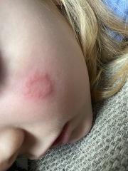 Rash in face