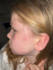 What is this!? Spot on face