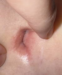 Belly button infection - TMI pic