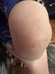 Rash on elbows