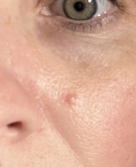 Is this a cyst?