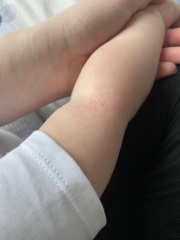 Dry skin