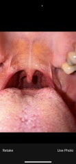 Globas or more serious? Consistant swallowing