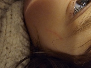 AIBU? - Facial scar 1 year old daughter
