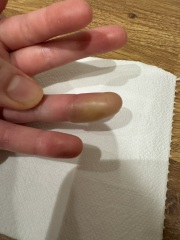 Cold sore and whitlow finger?!