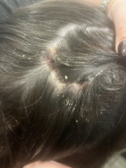 Open sores on scalp