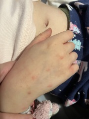 Dd aged for in hospital with quinsy tonsillitis last week, now has hives - what to do?