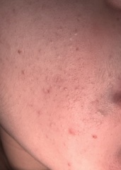 Acne/ face ?