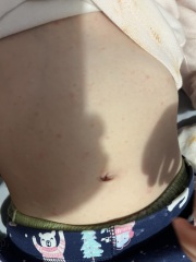 Dd aged for in hospital with quinsy tonsillitis last week, now has hives - what to do?