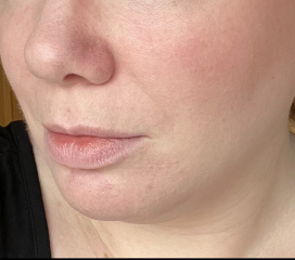 Acne on chin