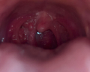 Red bump in back of throat