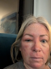 Possible cellulitis round eye, can't tell if it looks worse. Pics for opinions please!