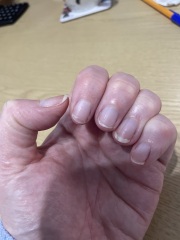 Proven treatments for natural peeling nails