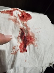 Is this a miscarriage? Sensitive images attached!