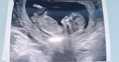 12 weeks 3 days gender??
