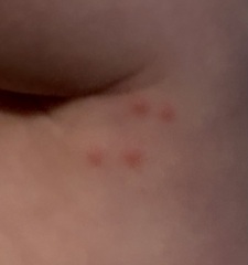 Does this look like chickenpox?