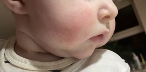 Allergy or teething?