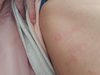 Christmas rash