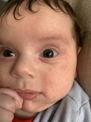 Baby acne/eczema or CMPA rash? Help pls.