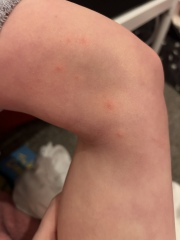 Bed bugs?!