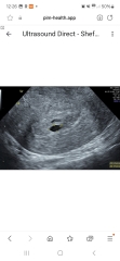 No yolk sac on scan