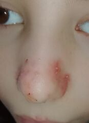 Child's skin infection on face and no one cares