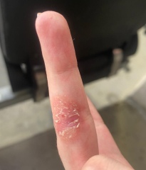 Is this Excema or something else, with photos.