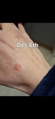 Hand infected (Warning, gross photos)