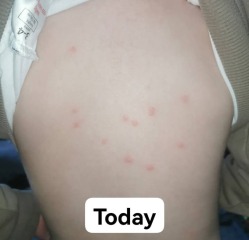 Chicken pox?
