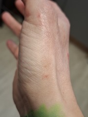 Hand infected (Warning, gross photos)