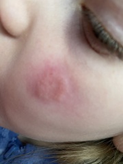 Rash in face