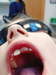 Any dentists? Child broken front tooth!
