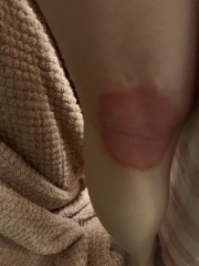 Eczema?