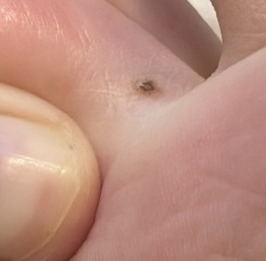 Abnormal moles?