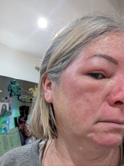 Possible cellulitis round eye, can't tell if it looks worse. Pics for opinions please!