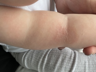 Dry skin