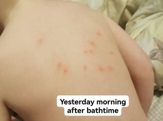 Chicken pox?