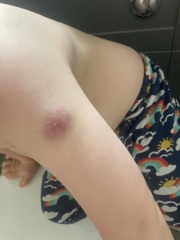 BCG scar popped 2nd time on my 4 month old's arm