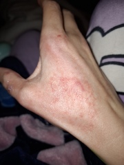 Hand infected (Warning, gross photos)