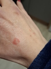 Hand infected (Warning, gross photos)