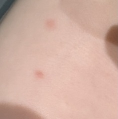 Does this look like chickenpox?