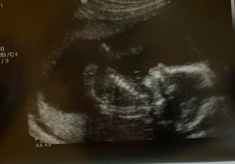 17 week skull theory ?